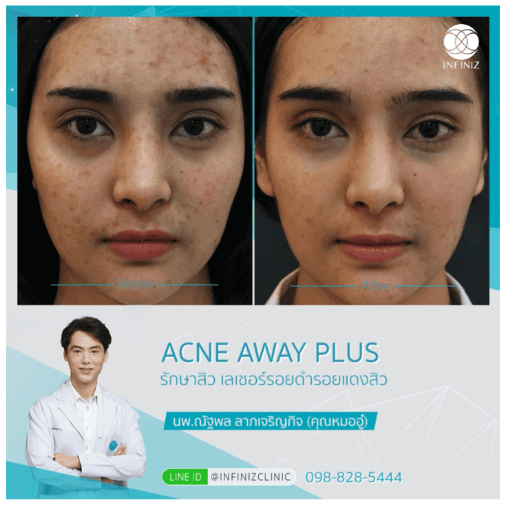 Acne Away Plus 6