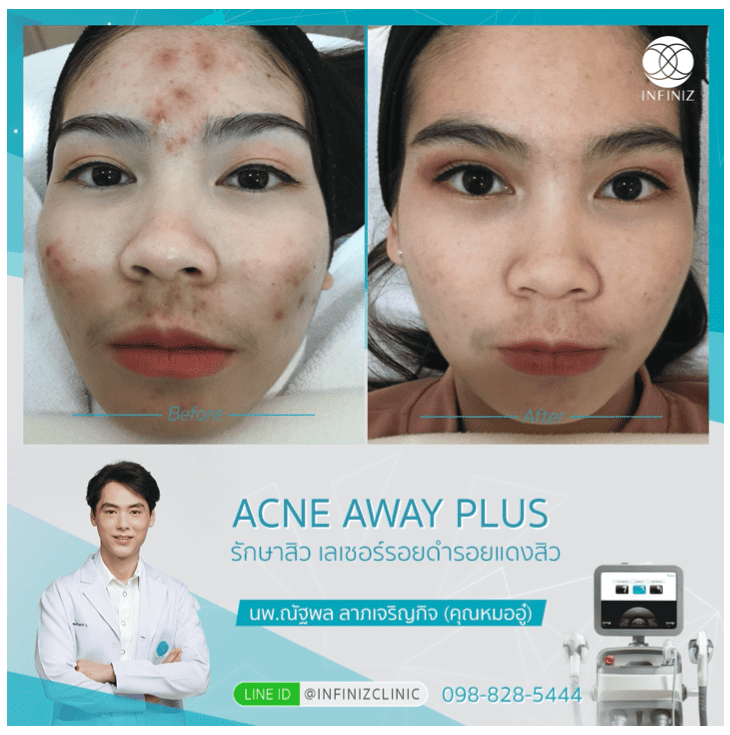 Acne Away Plus 8