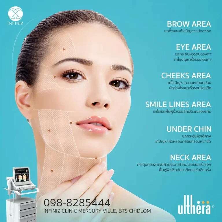 ulthera ทำบริเวณไหนได้บ้าง