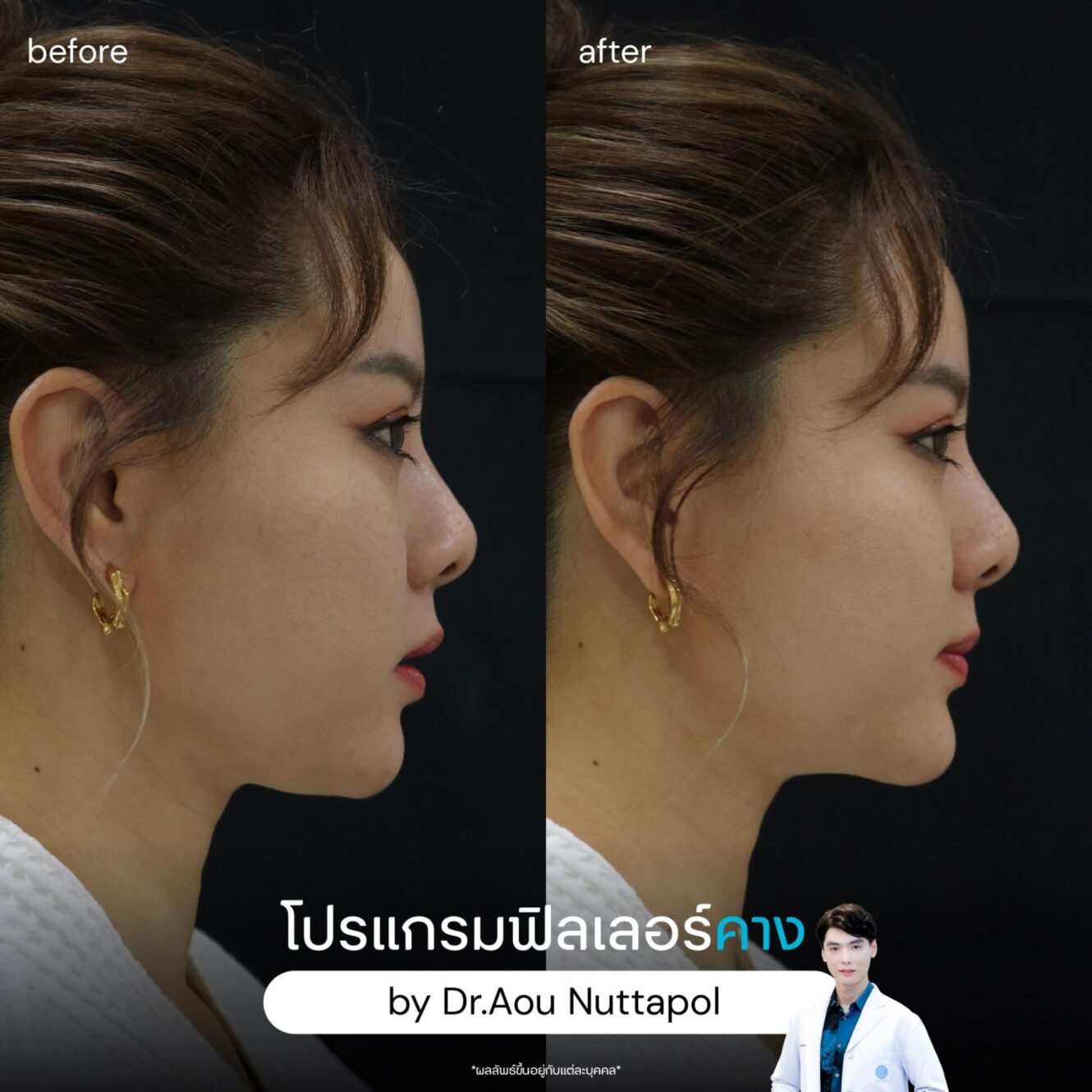 ก่อนฉีดฟิลเลอร์คาง