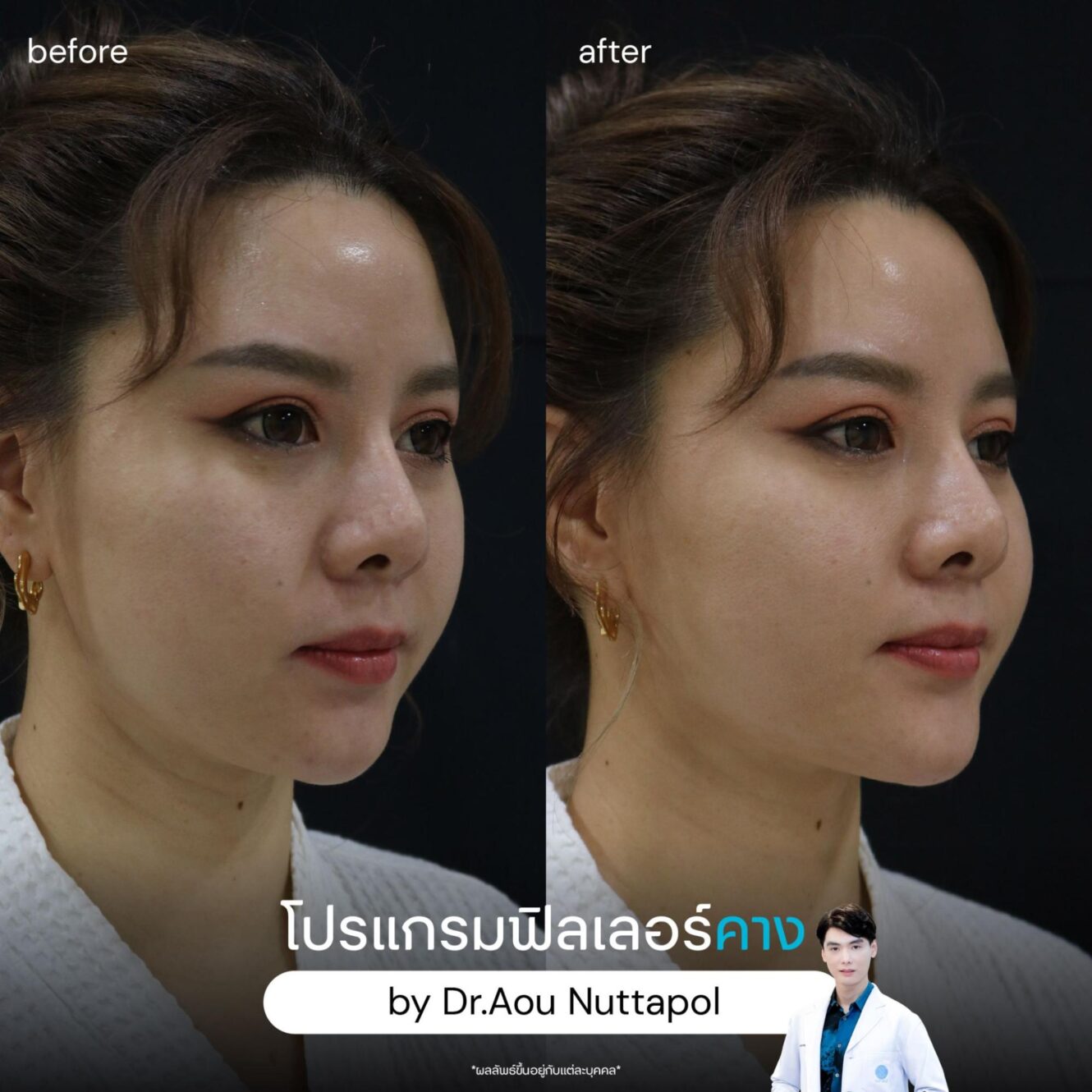 ฟิลเลอร์คาง ข้อดี