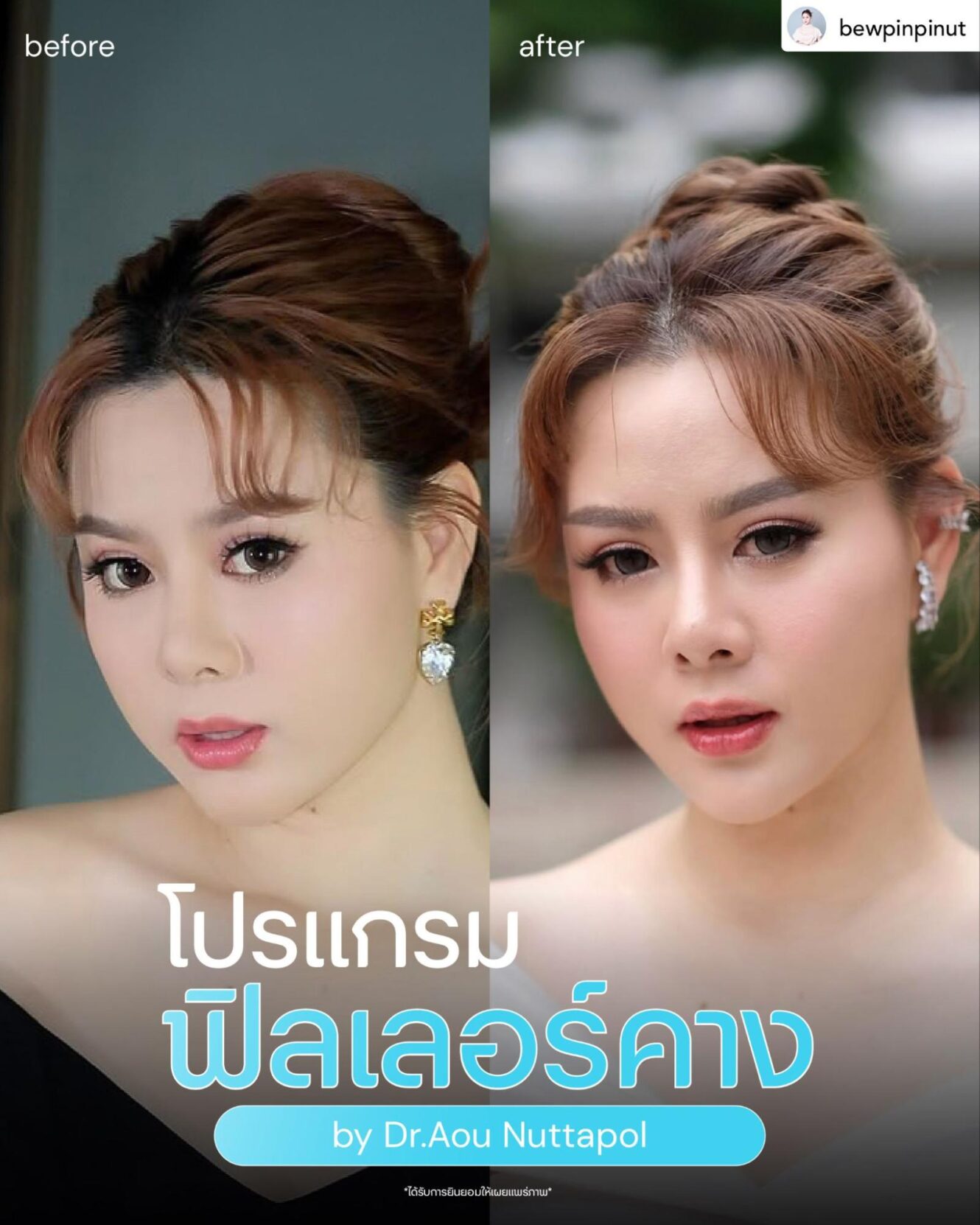 ฟิลเลอร์คาง คือ