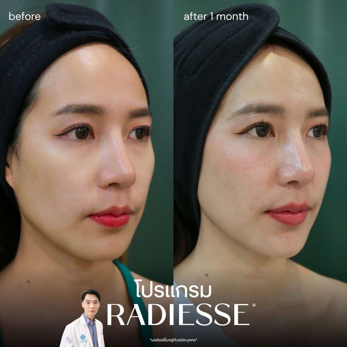 radiesse-review-3