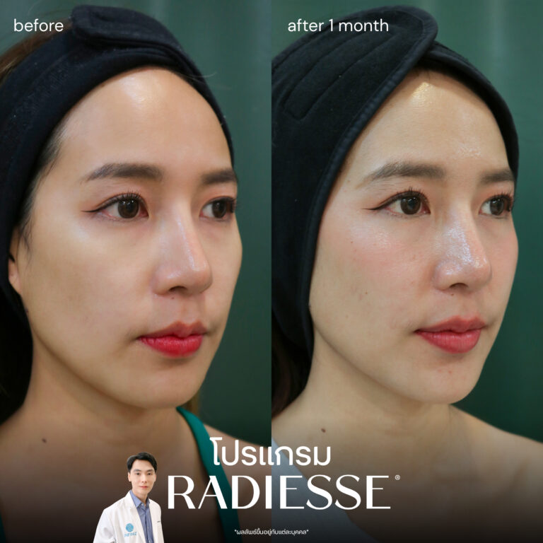 radiesse-review-3