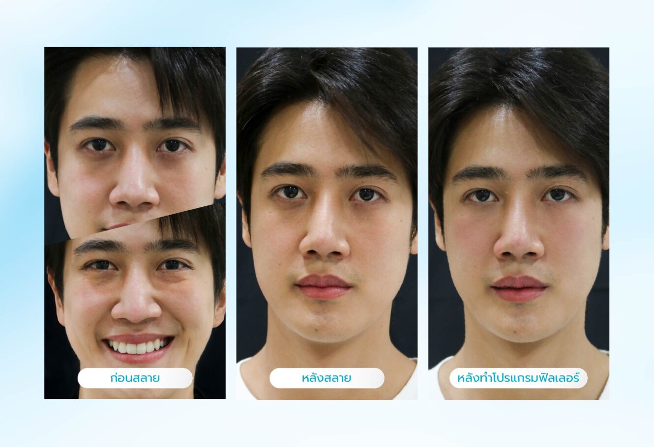 โปรแกรมสลายฟิลเลอร์คืออะไร? อันตรายหรือเปล่า? มีผลข้างเคียงอะไรไหม? 4 MBWeb Jul 25 03 1