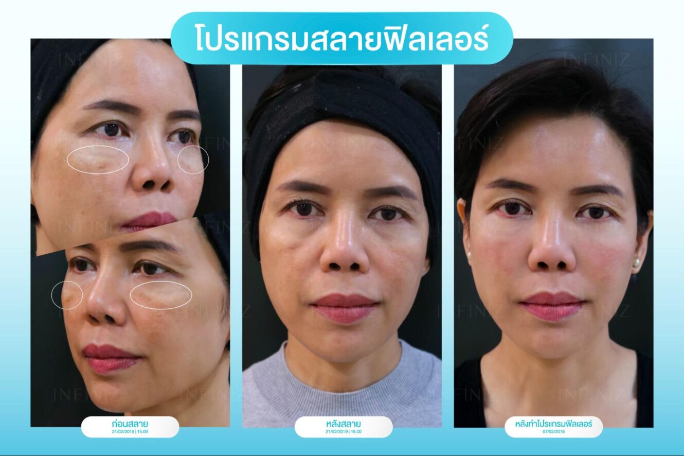 โปรแกรมสลายฟิลเลอร์ผลข้างเคียง