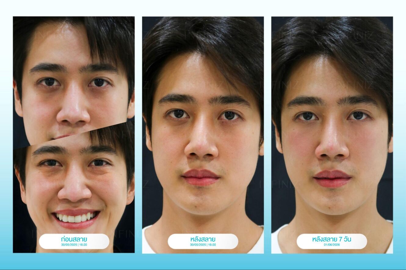 ฟิลเลอร์สลายหมดไหม