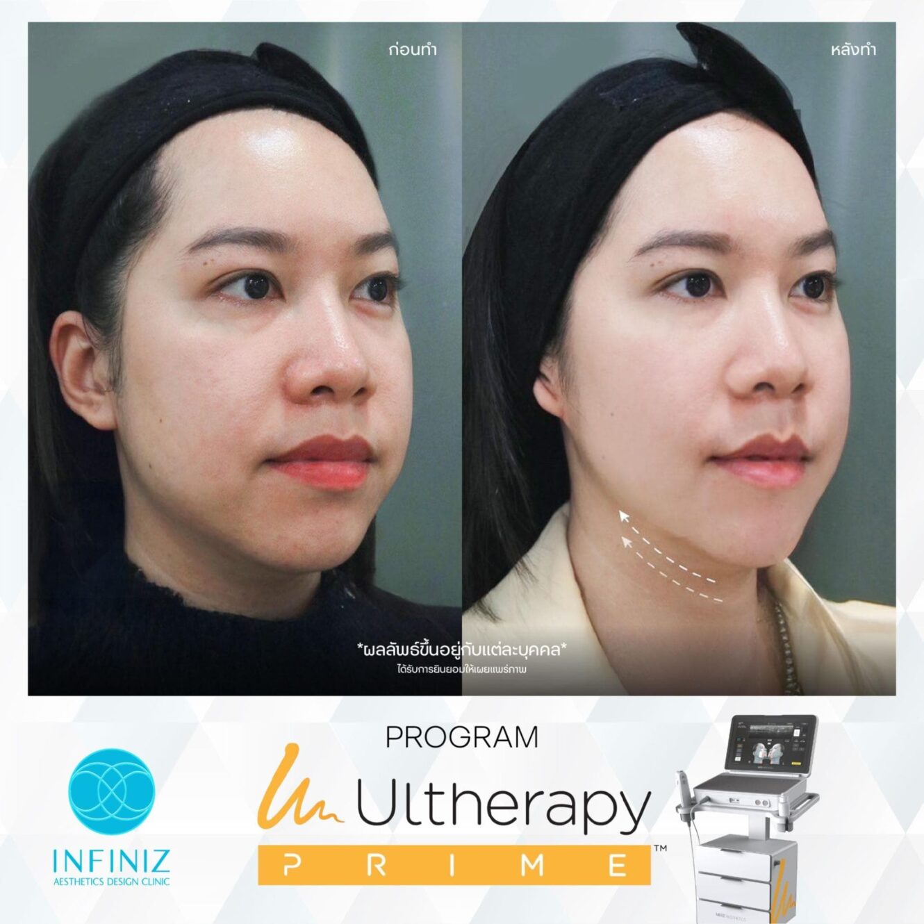 Ulthera ดีไหม