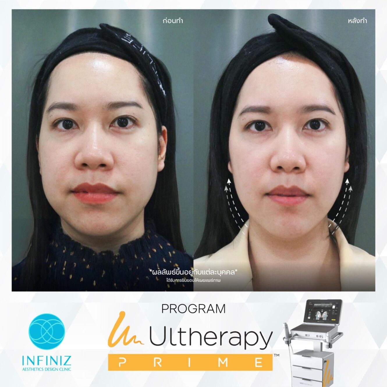 Ulthera ดียังไง