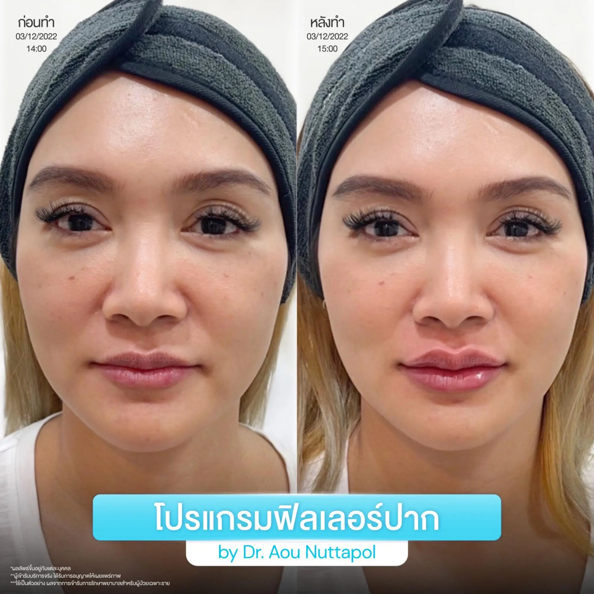 ทำโปรแกรมฟิลเลอร์ปากที่ INFINIZ Clinic