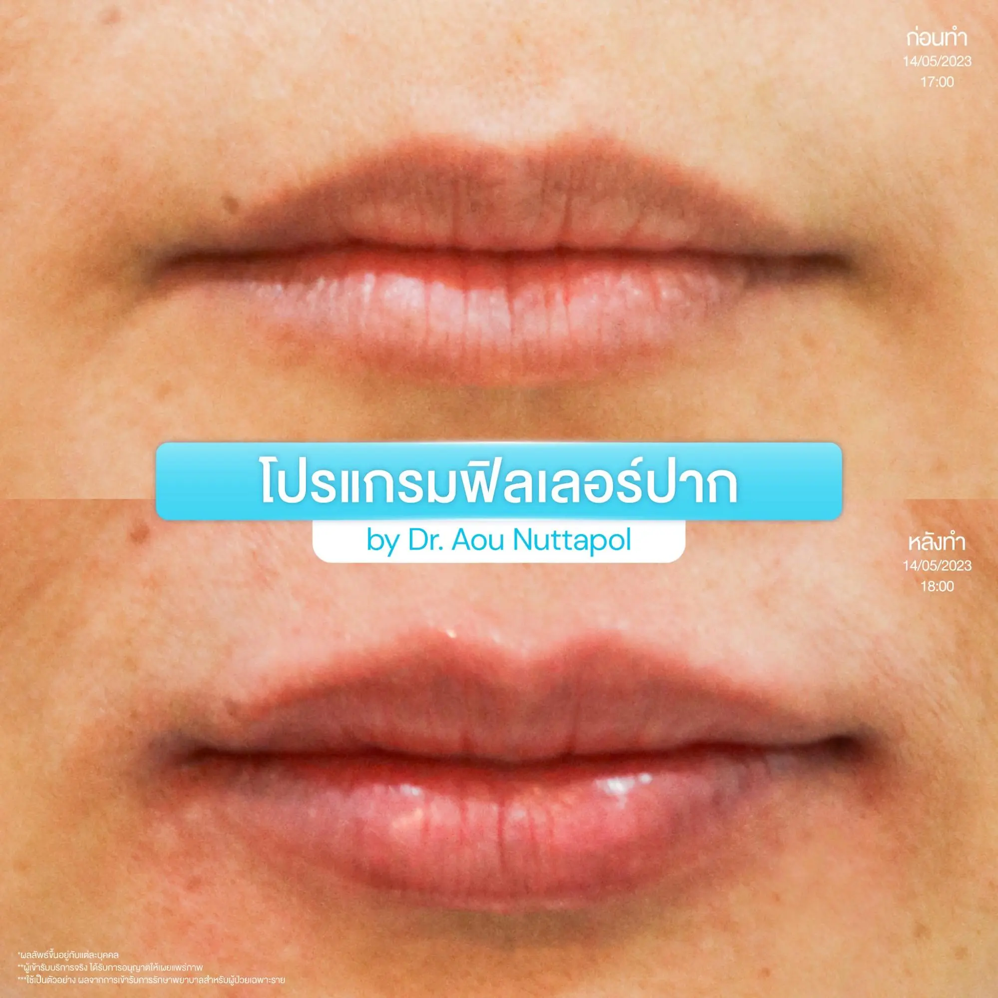 ทำโปรแกรมฟิลเลอร์ปากแต่ละยี่ห้อ