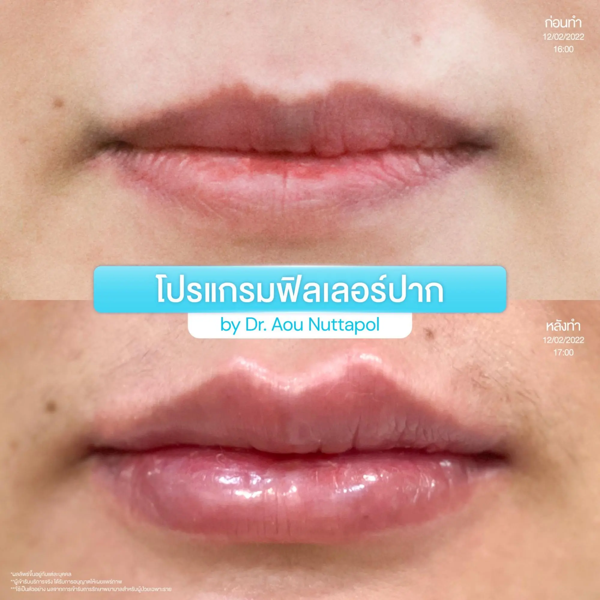 รีวิวทำโปรแกรมฟิลเลอร์ปาก