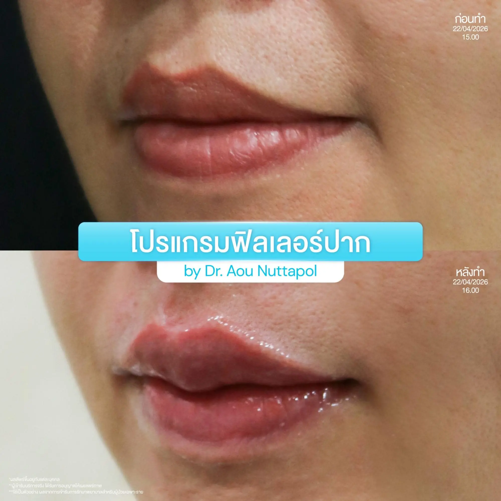 รีวิวโปรแกรมฟิลเลอร์ปาก