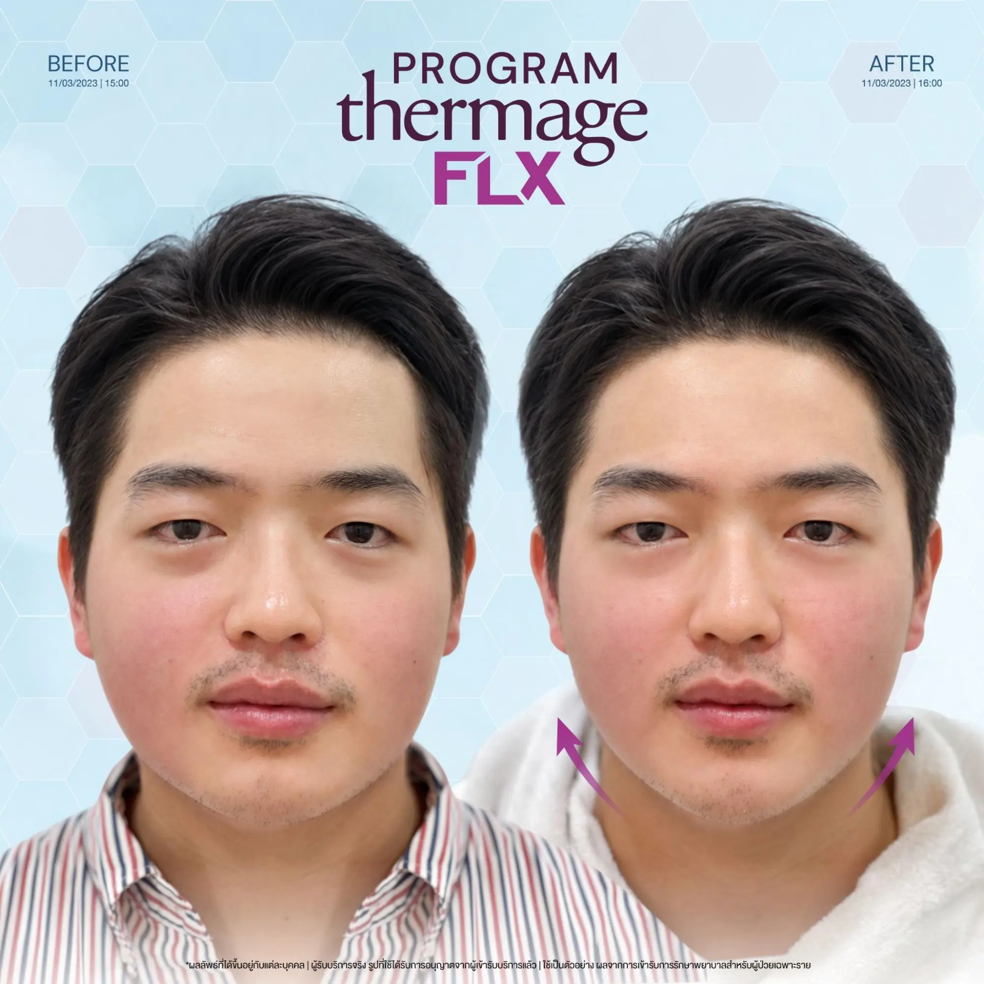 Thermage กับ Ulthera เห็นผลเมื่อไหร่