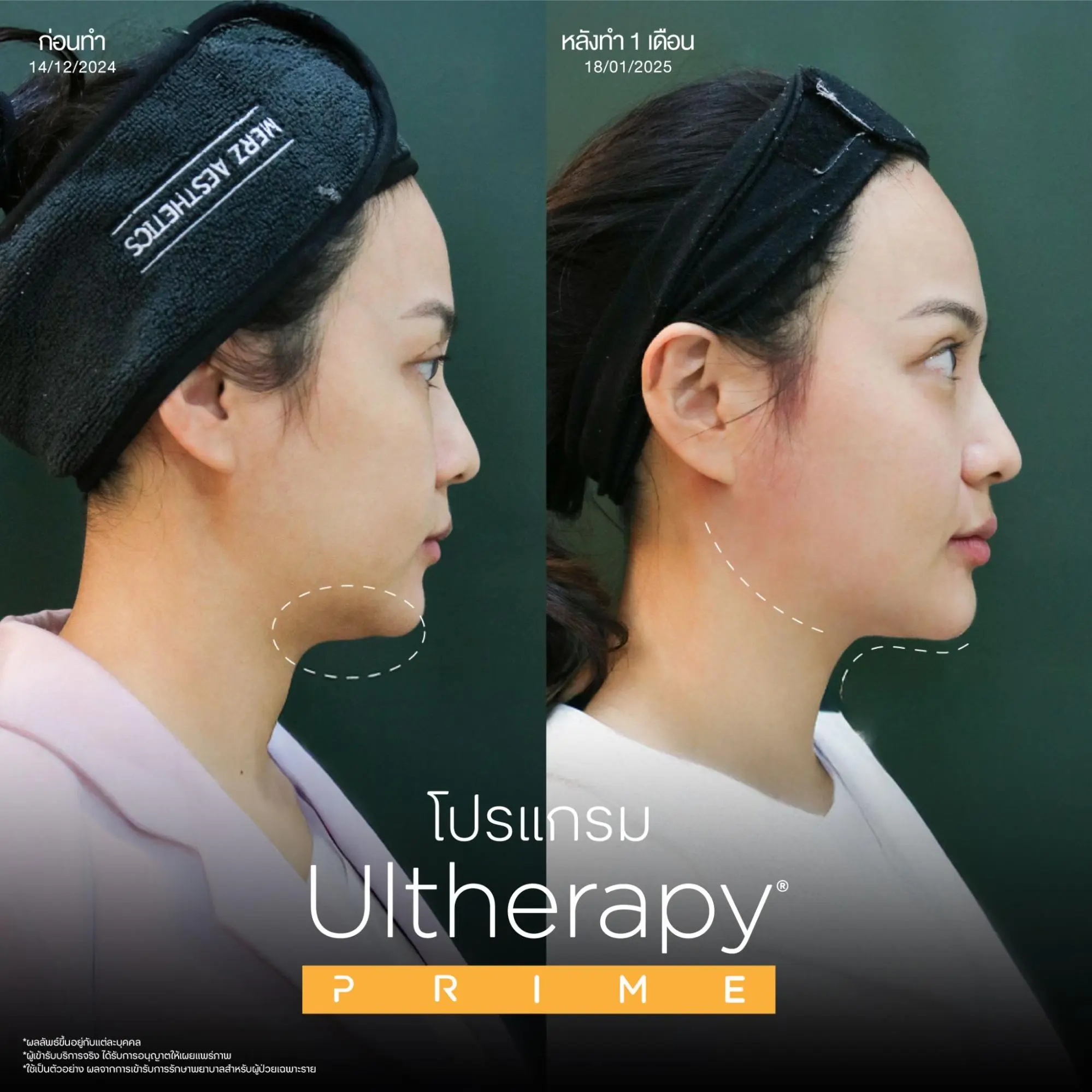 โปรแกรม Ulthera คืออะไร