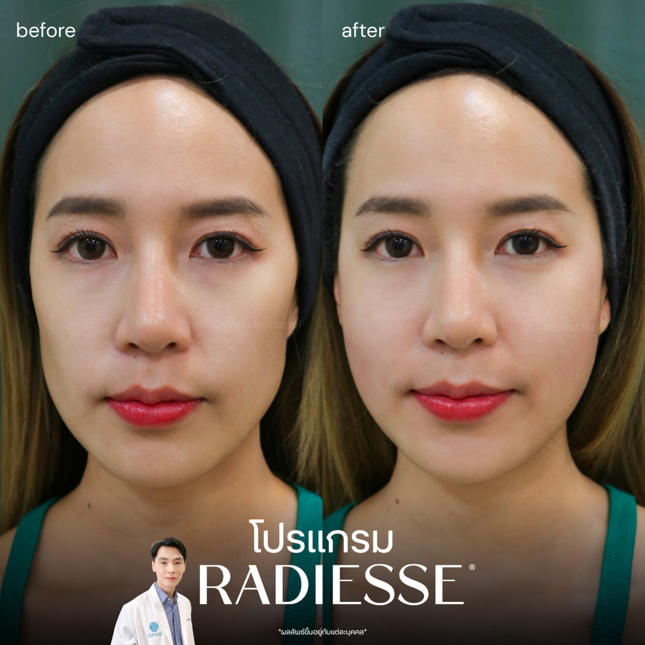 radiesse-review-1