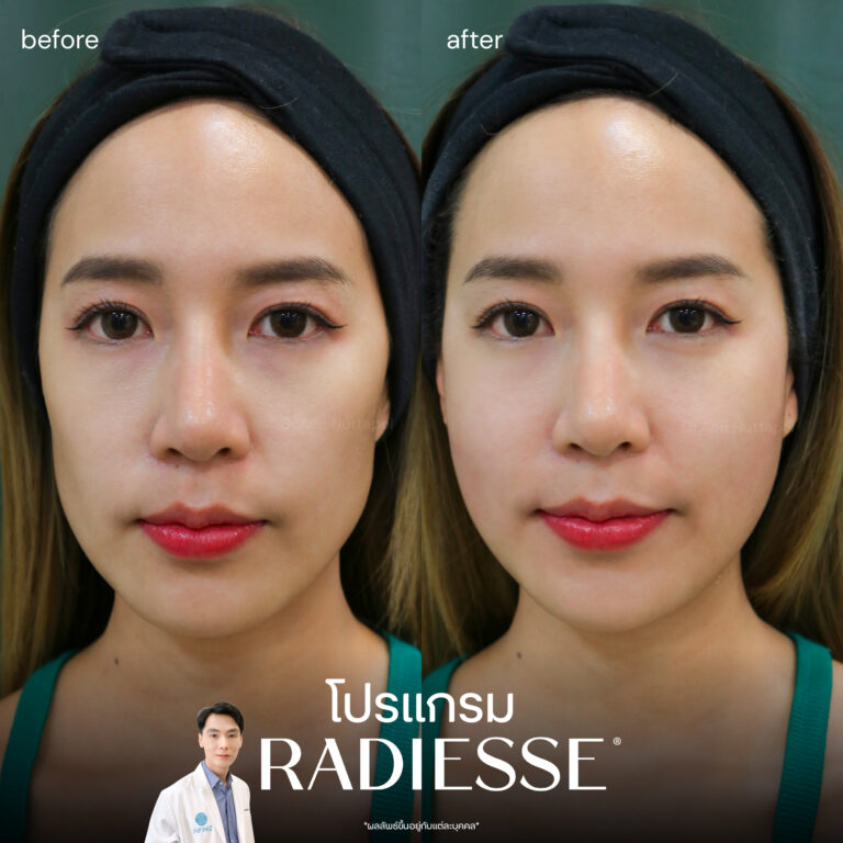 radiesse-review-1