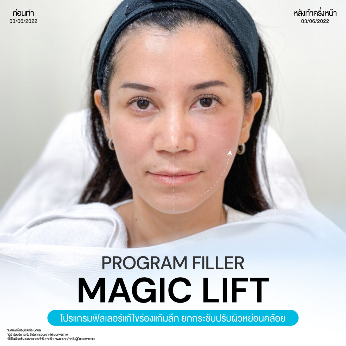 โปรแกรมฟิลเลอร์ยกกระชับช่วยปรับรูปหน้าให้ละมุน 1 Magic Lift 01