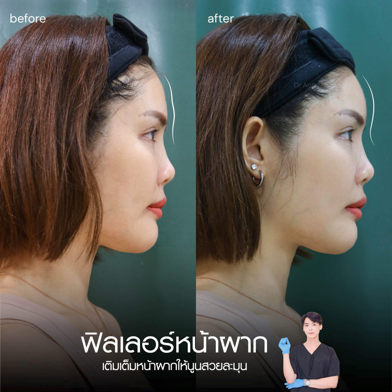 BA Filler หน้าผาก 01