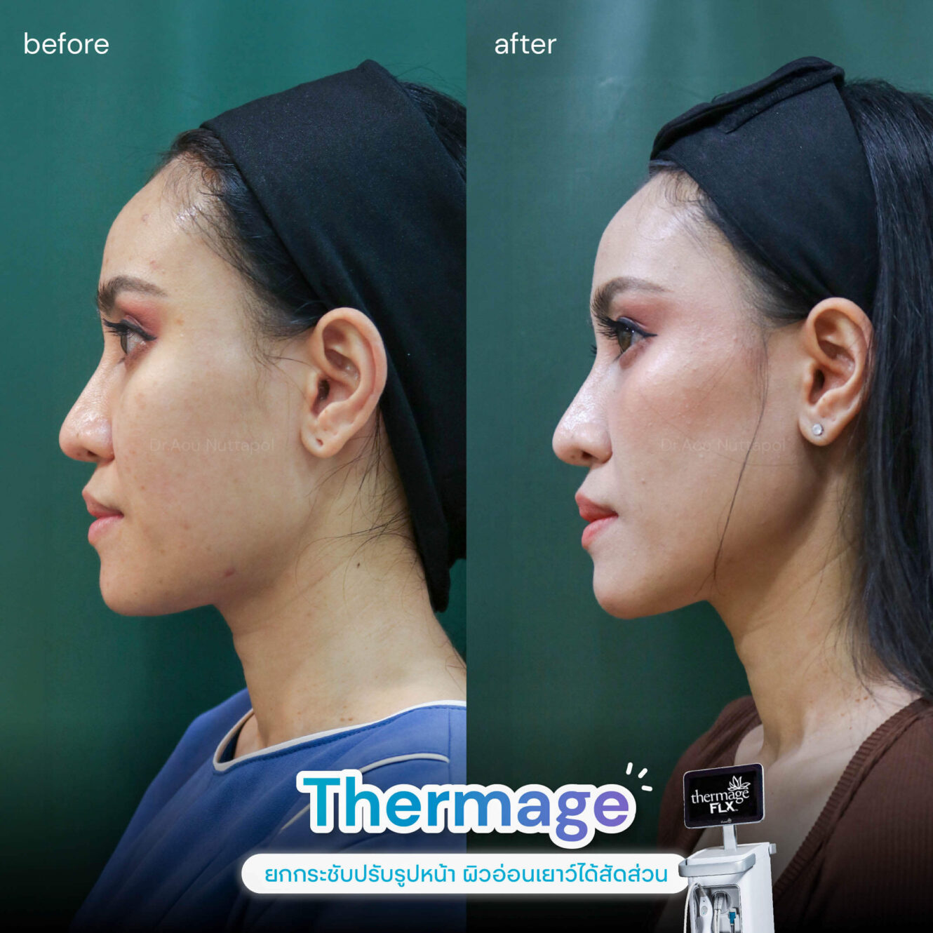 BA Thermage 04