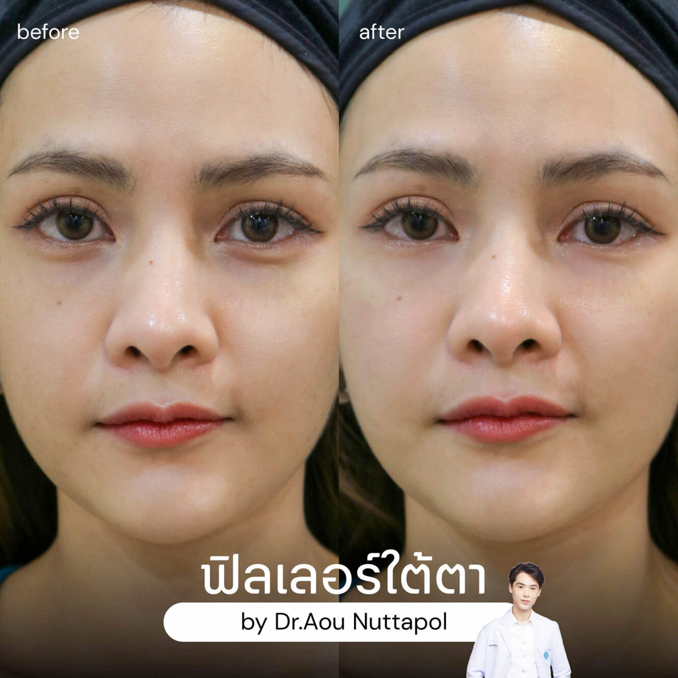 BA filler ใต้ตา 01