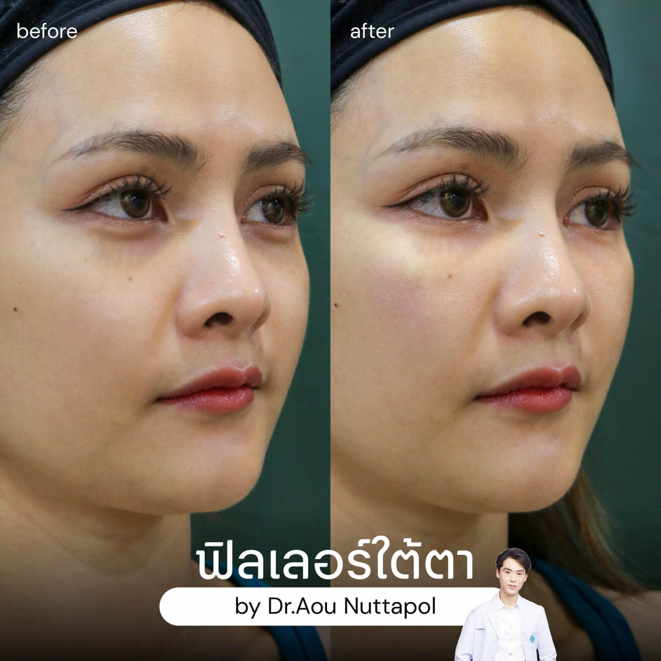 BA filler ใต้ตา 02