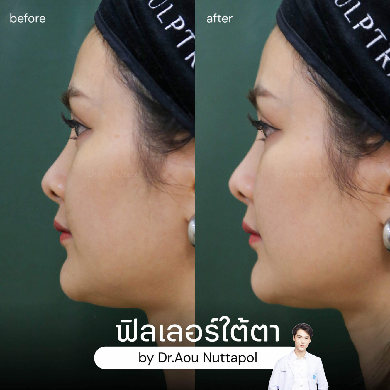 BA filler ใต้ตา 03