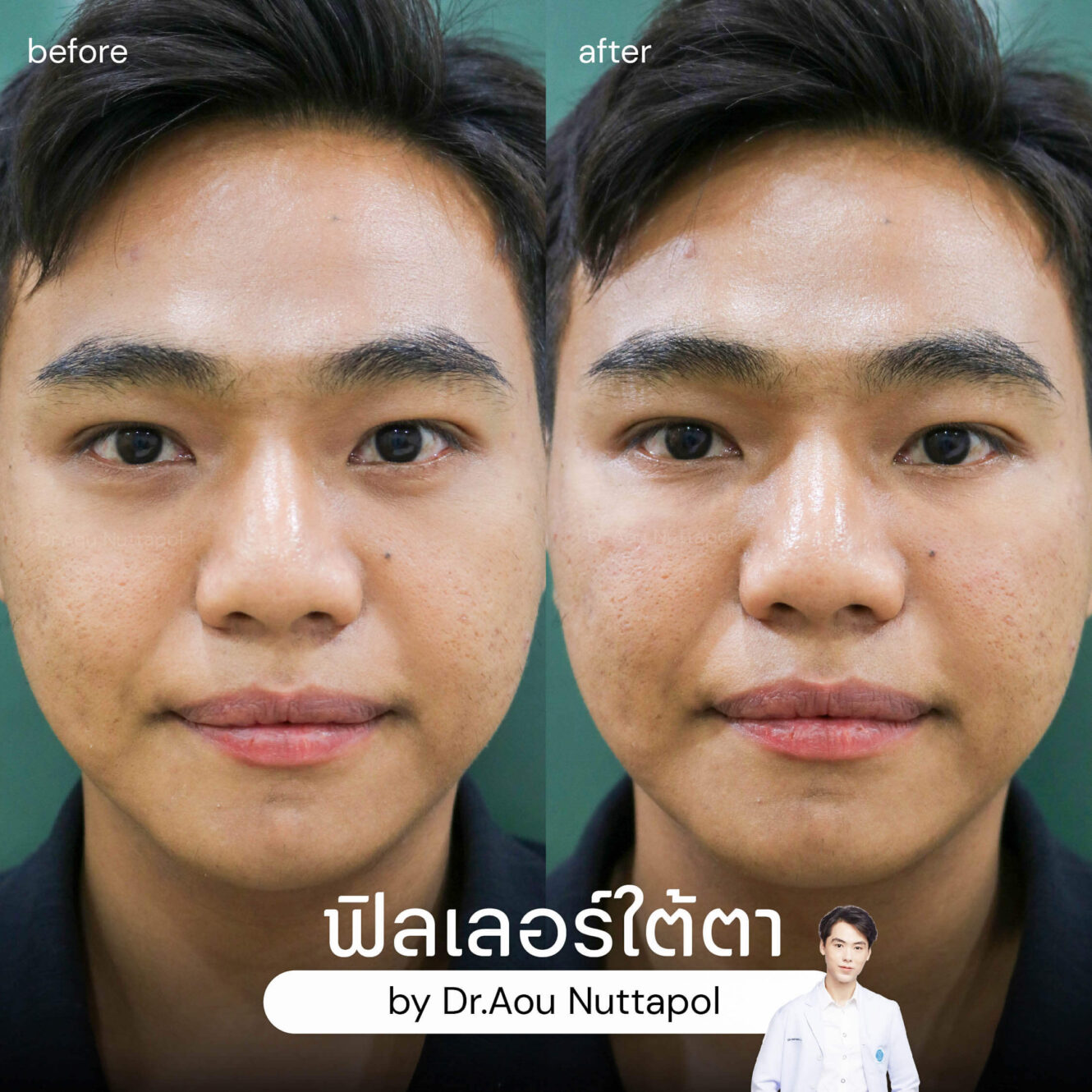 BA filler ใต้ตา 04