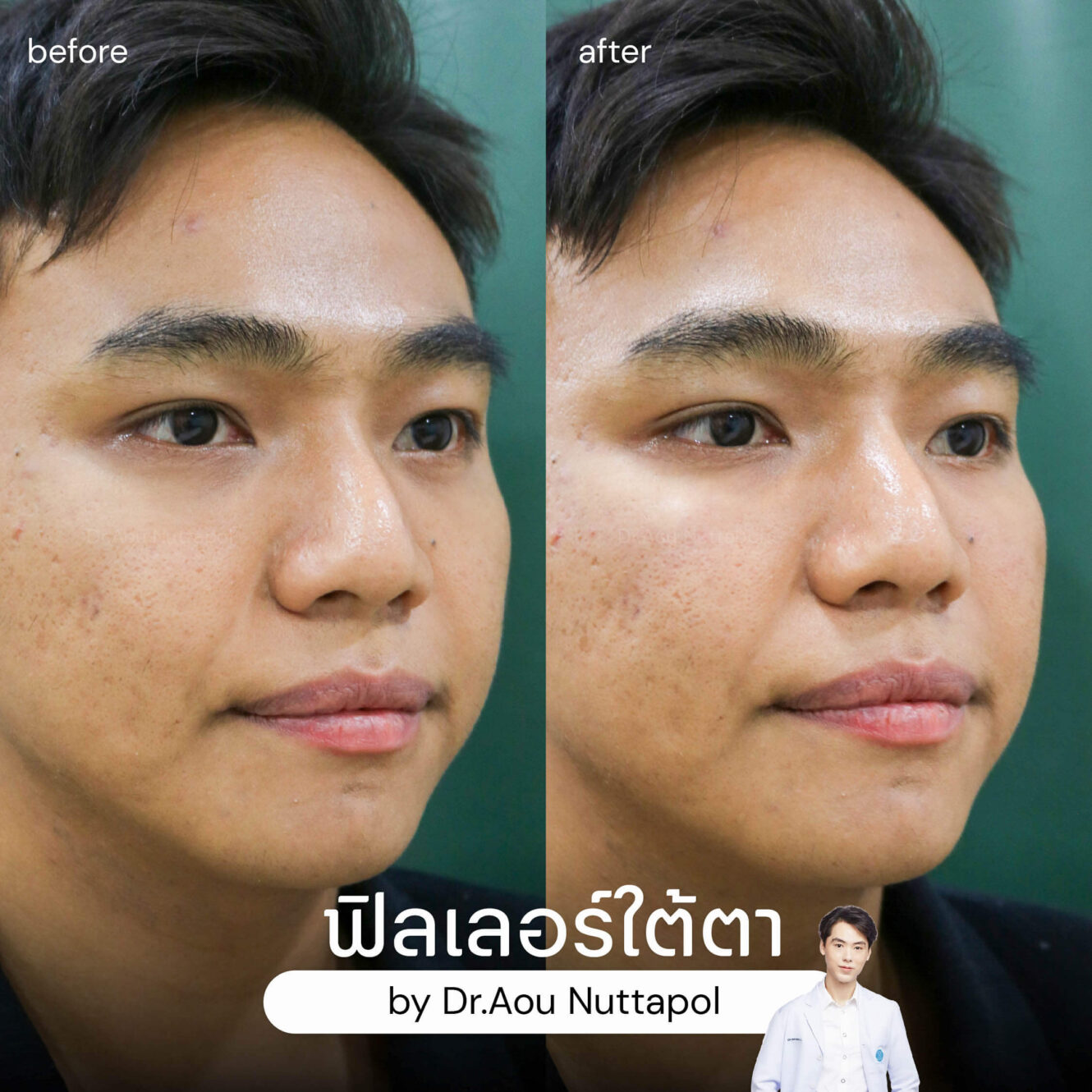 BA filler ใต้ตา 05