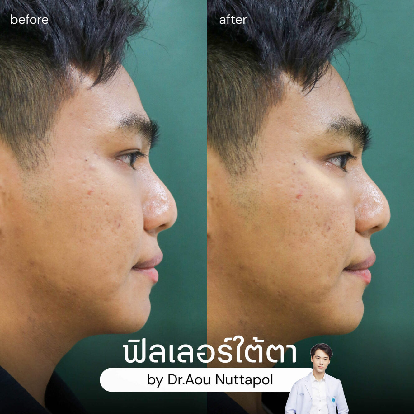 BA filler ใต้ตา 06