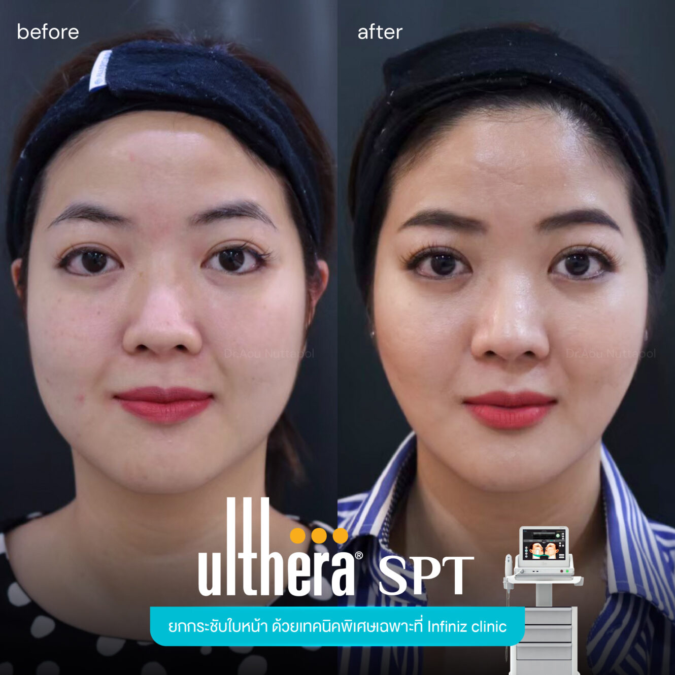 BA Ultherapy 02