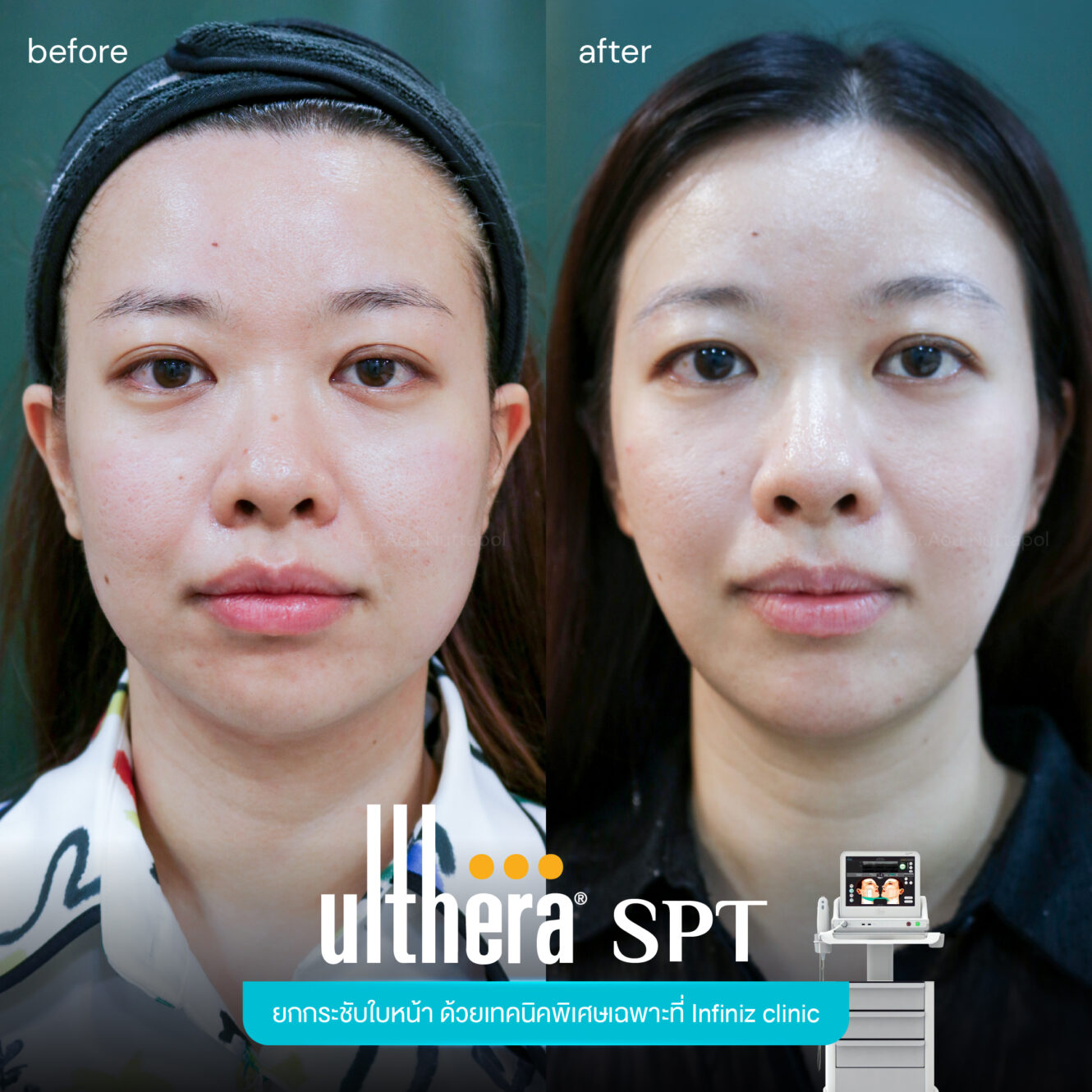 BA Ultherapy 04