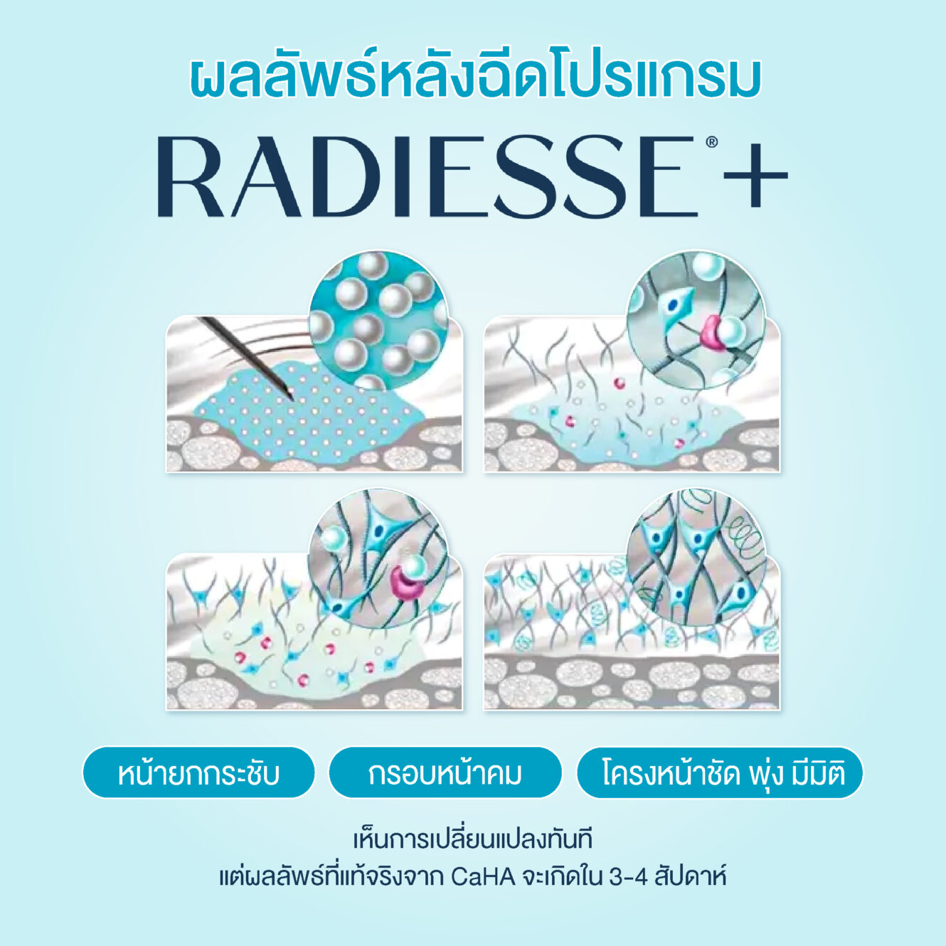 Radiess 04