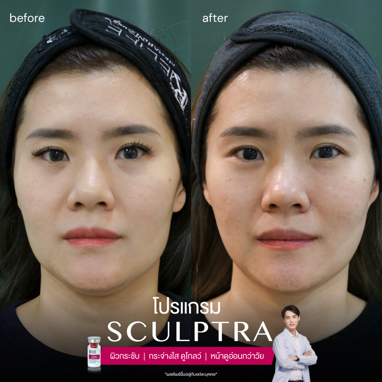 Sculptra-review-3