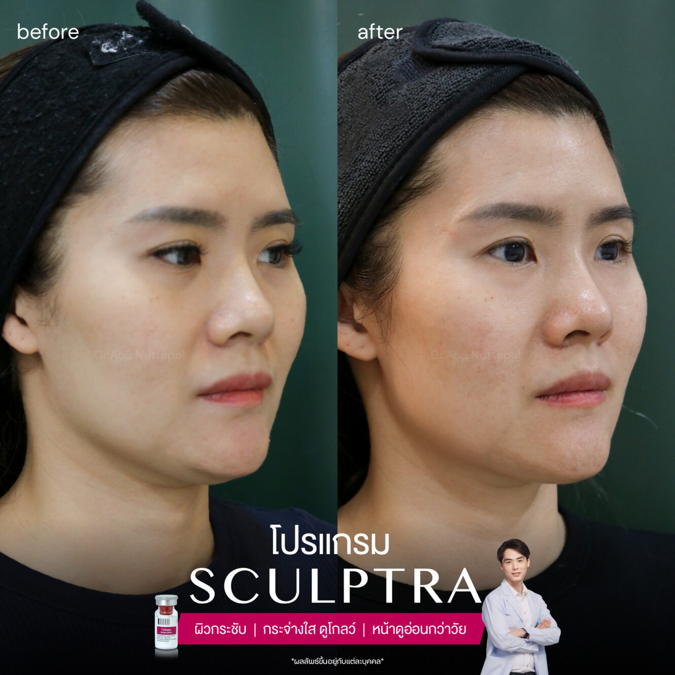 Sculptra-review-3