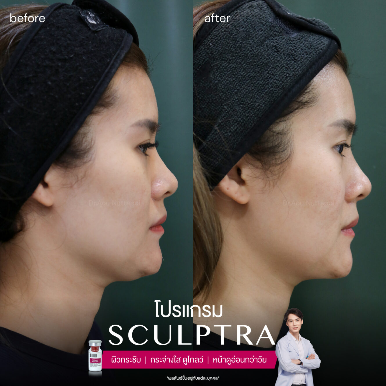 Sculptra-review-2