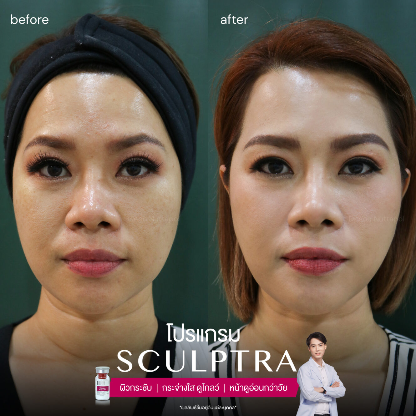 Sculptra-review