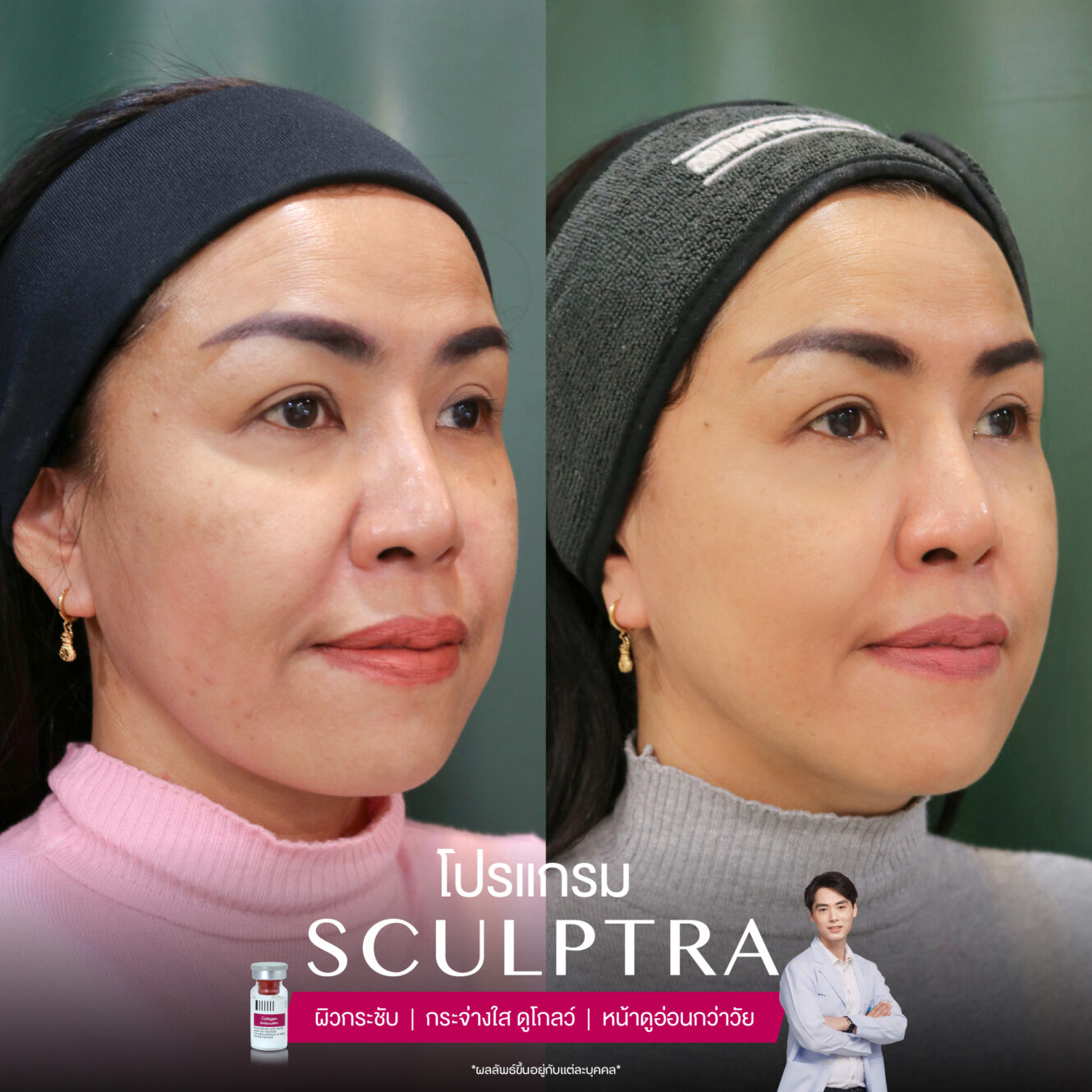 Sculptra-review-4