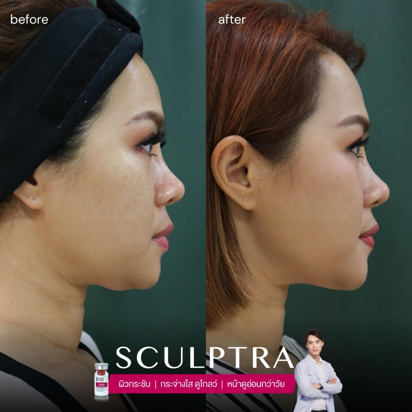 Sculptra Review