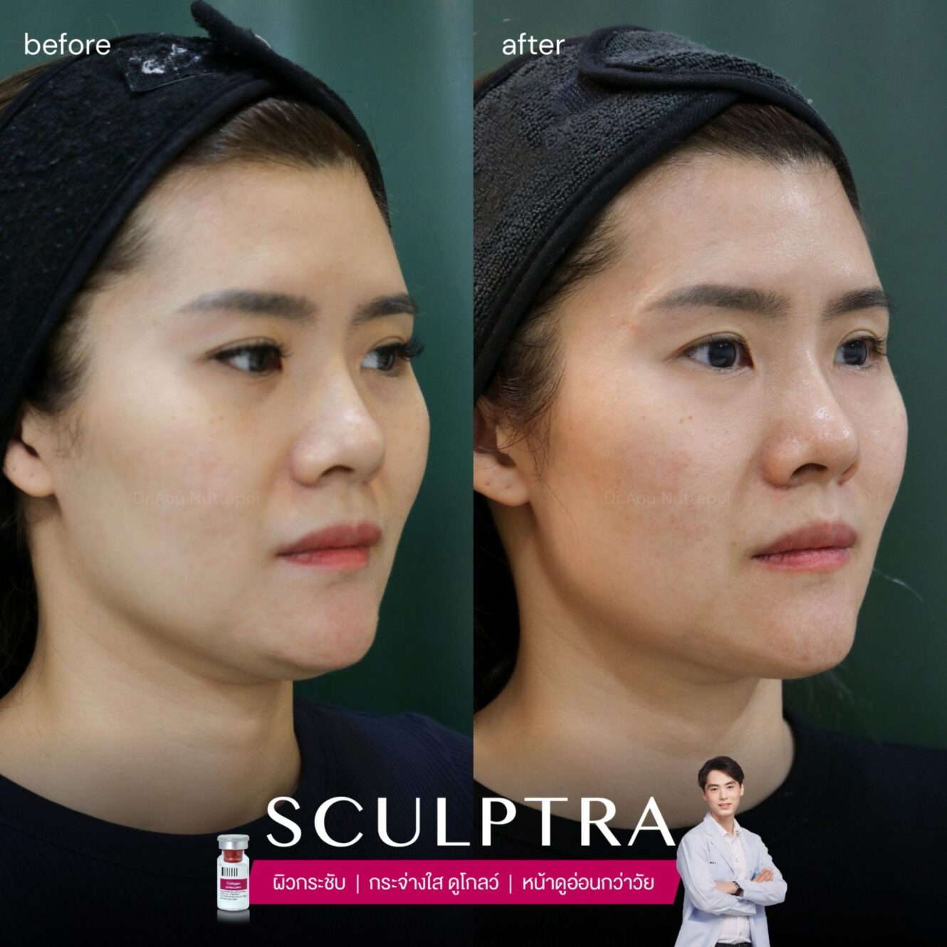 รีวิว Sculptra