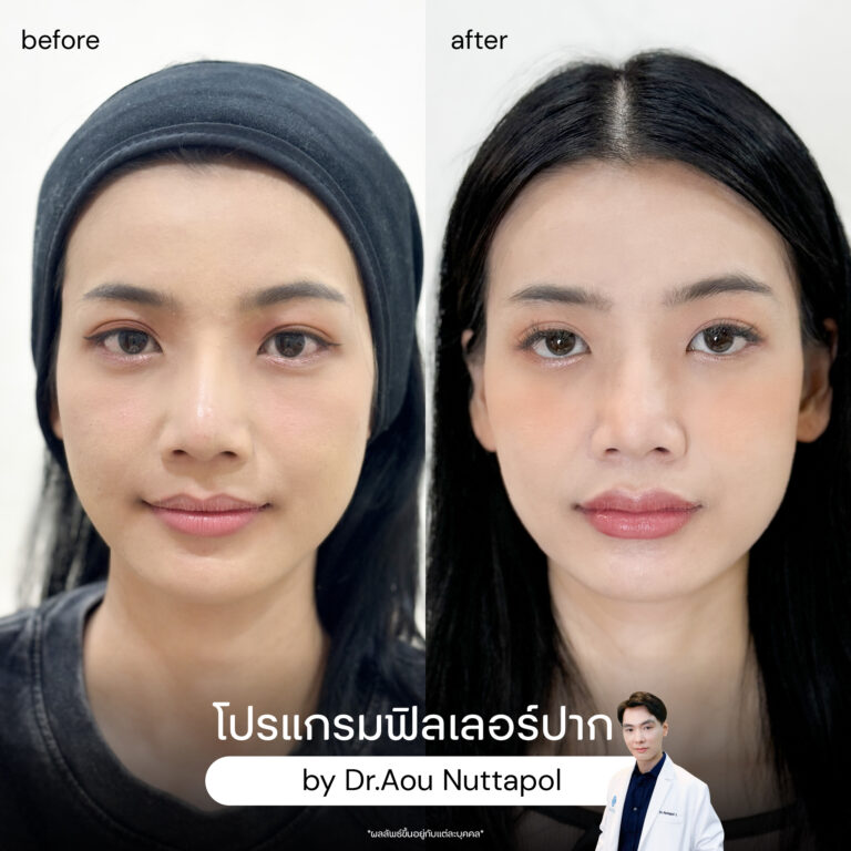 ฉีดฟิลเลอร์ปากครั้งแรกต้องรู้อะไรบ้าง? ราคาเท่าไหร่ อยู่ได้นานแค่ไหน 9
