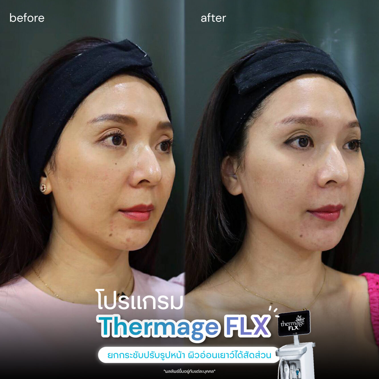 Thermage-review-2