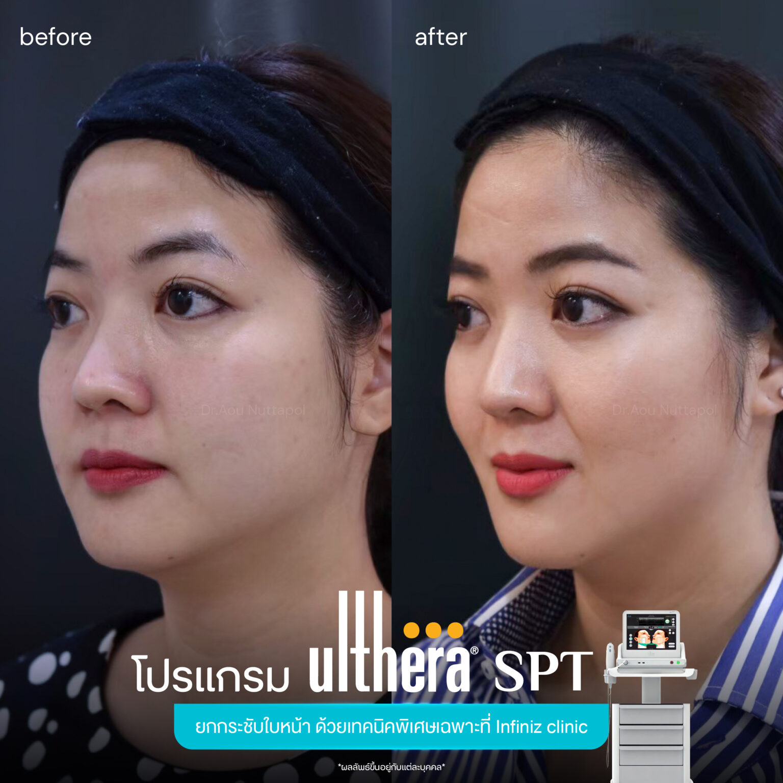 Ulthera-spt-review-4
