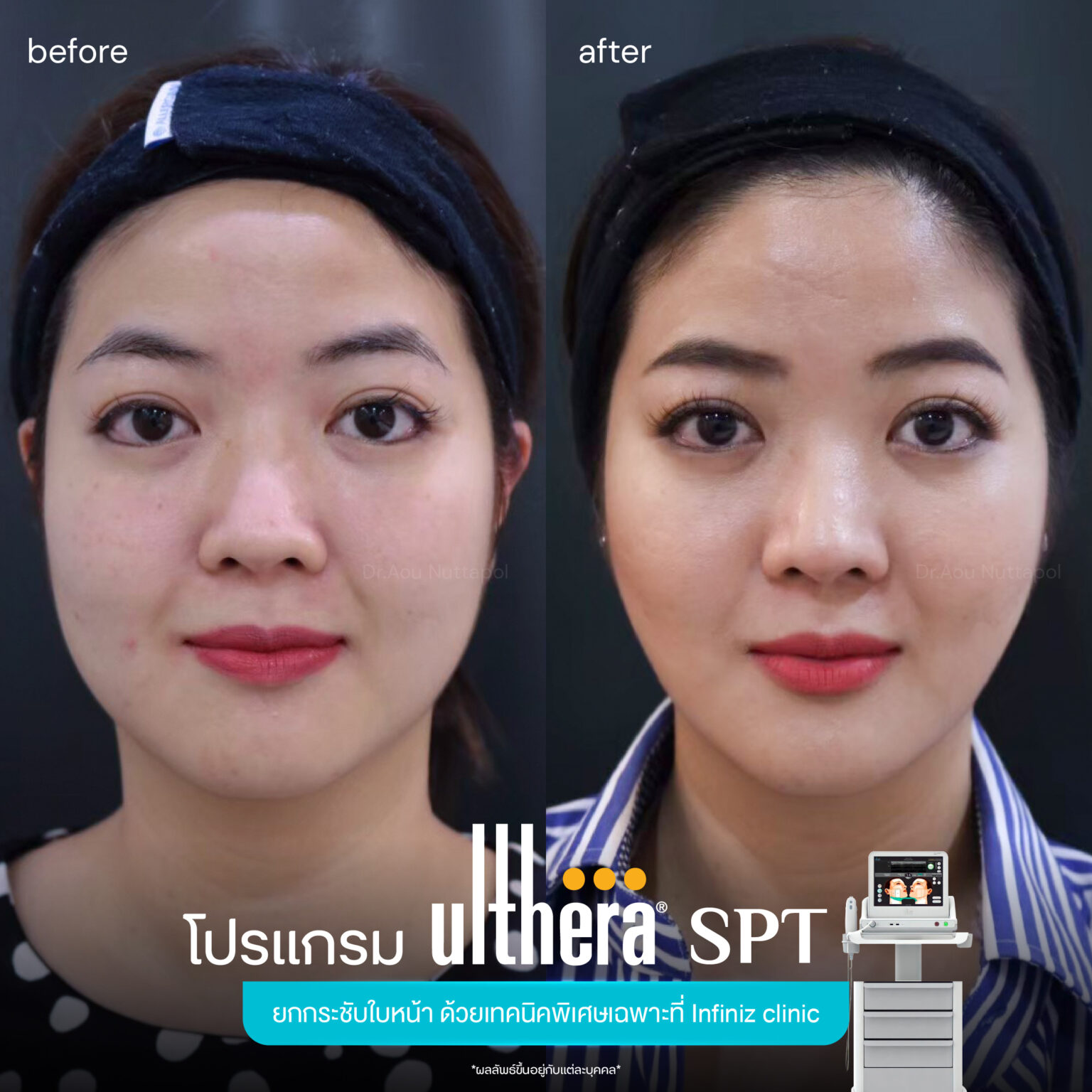 Ulthera-spt-review-3