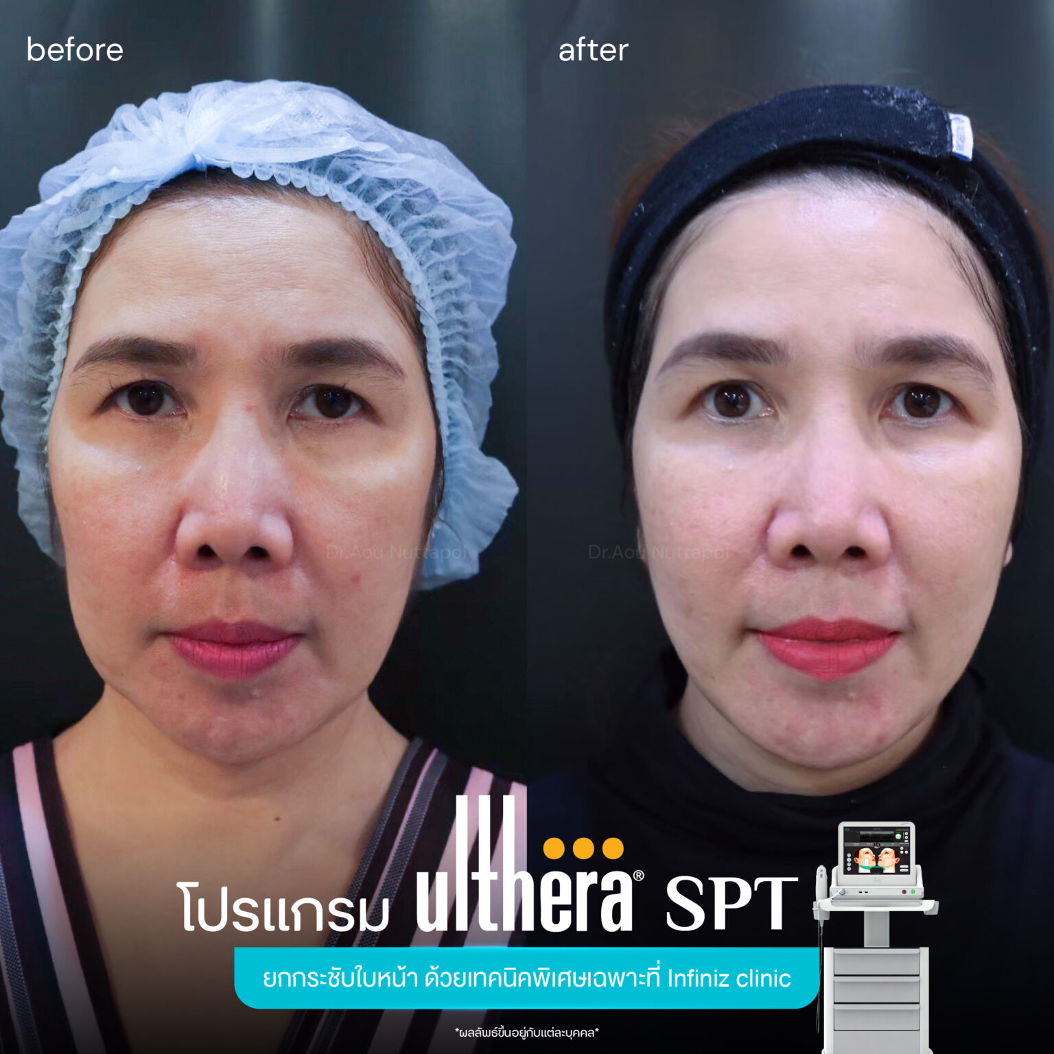 Ulthera-spt-review-2