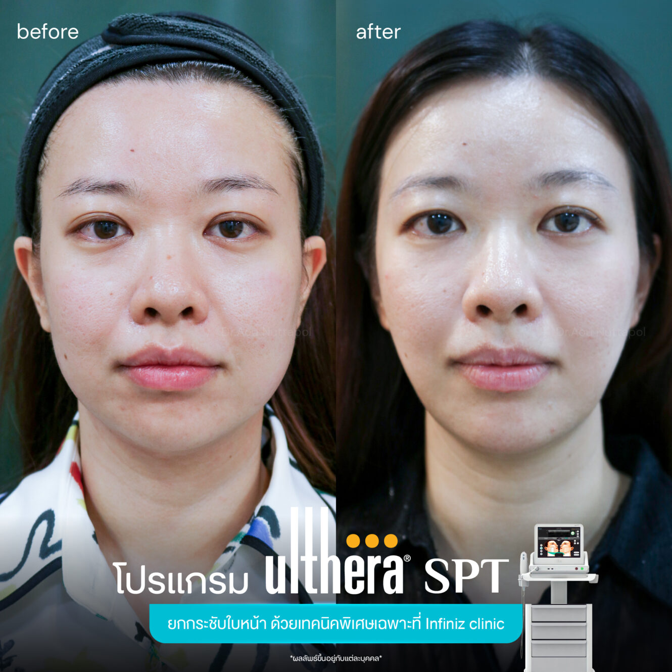 Ulthera-spt-review-1