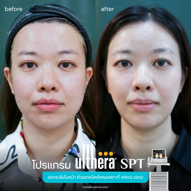 Ulthera-spt-review-1