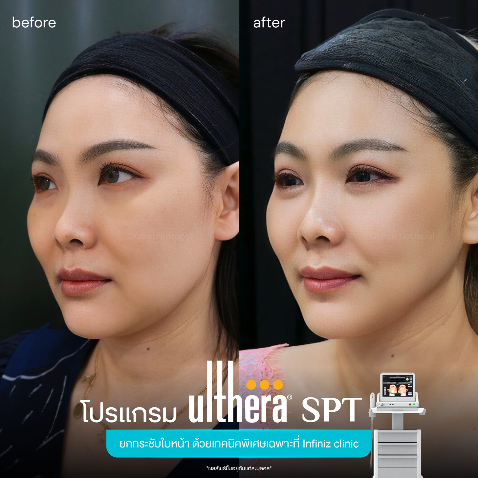 Ulthera-spt-review