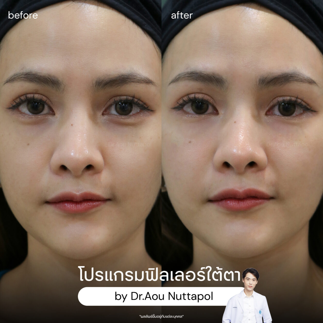 BA filler ใต้ตา 01