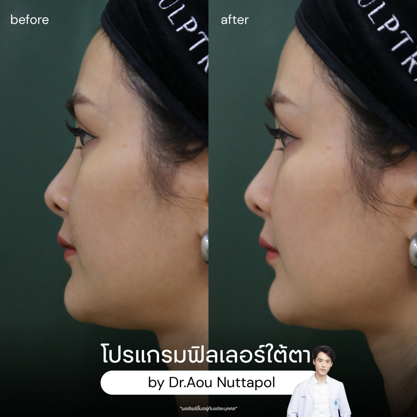 BA filler ใต้ตา 03